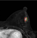 Image Manifold Revealing for Breast Lesion Segmantation in DCE-MRI
