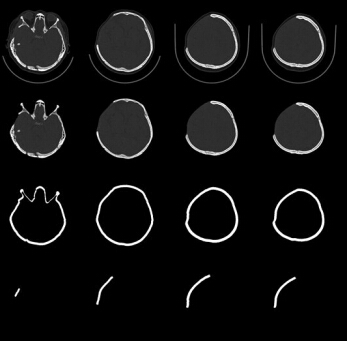 Skull defect reconstruction based on a new hybrid level set