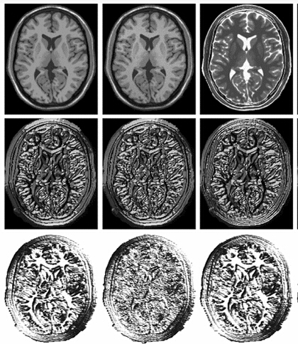 miLBP: a robust and fast modality-independent 3D LBP for multimodal deformable registration