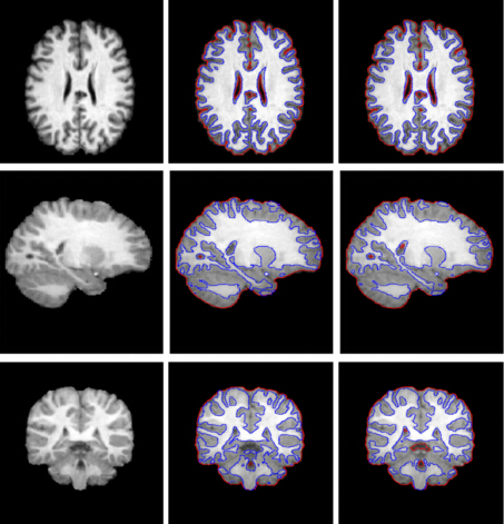 Segmentation of MR Image Using Local and Global Region Based Geodesic Model