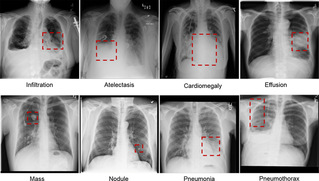 Computer-aided detection in chest radiography based on artificial intelligence: a survey