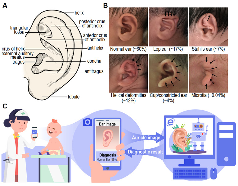 [eClinicalMedicine] Artificial intelligence assisted identification of newborn auricular deformities via smartphone application