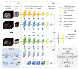 [JMRI] A Multiparametric Fusion Deep Learning Model Based on DCE-MRI for Preoperative Prediction of Microvascular Invasion in Intrahepatic Cholangiocarcinoma