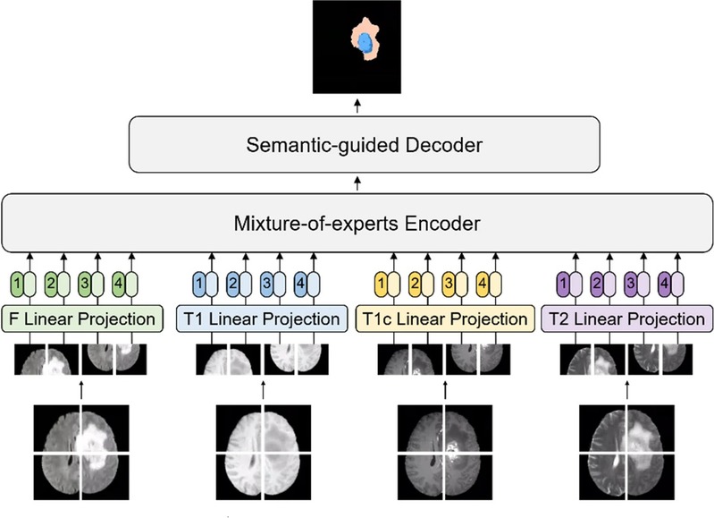 [MBEC] Mixture-of-experts and semantic-guided network for brain tumor segmentation with missing MRI modalities