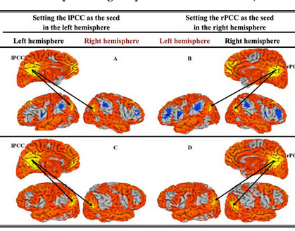 Alteration of the Intra- and Cross- Hemisphere Posterior Default Mode Network in  ……