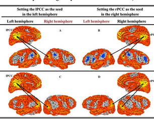 Alteration of the Intra- and Cross- Hemisphere Posterior Default Mode Network in  ……