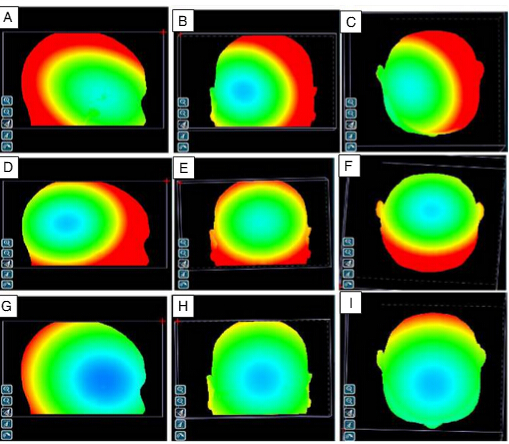 Anatomical landmarks for point-matching registration in image-guided neurosurgery