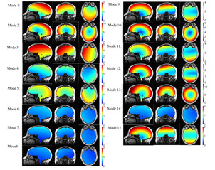 Regional-surface-based registration for image-guided neurosurgery: Effects of scan modes on...